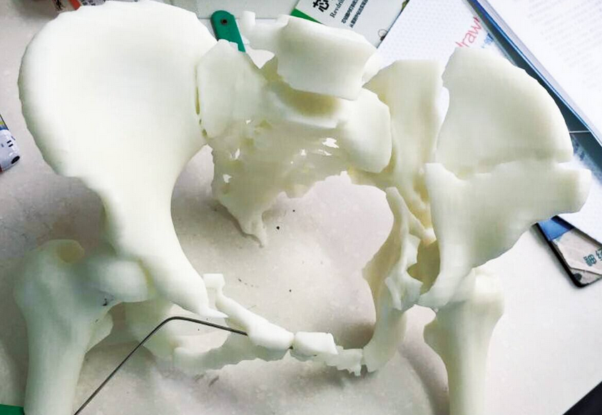 3D打印外科模型应用案例